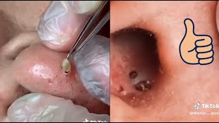 30 Min of the Most Satisfying Pimple Pops amp Cyst Extractions  Ultimate Pimple Popping Compilation [upl. by Maris533]