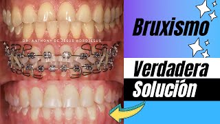 TRATAMIENTO PARA EL BRUXISMO CON BRACKETS ANTES Y DESPUÉS  CASO EXTREMO REAL [upl. by Nawrocki]