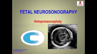 Fetal Neurosonography – Holoprosencephaly [upl. by Ilajna]