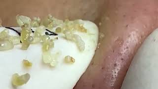 Big Cystic Acne Extraction Blackheads Milia Whiteheads Removal Pimple Popping Compilation 10003 [upl. by Mcadams490]