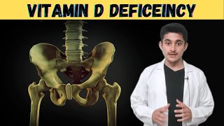 Osteomalacia 3d animation  Vitamin D function deficiency  cause symptoms  pathophysiology  hindi [upl. by Alison912]