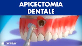 Apicectomia dentale © [upl. by Johathan]