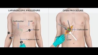 What are Gallstones Causes Symptoms  Treatment of Gallstone [upl. by Aneehc]