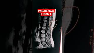 Paraspinal Lipoma mri shorts mriradiographer MRI Dorso Lumbar Spine  T1W Sequence [upl. by Martin697]