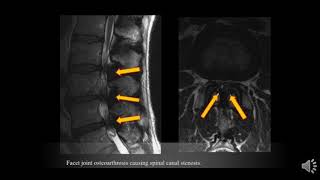 TMT MRI SPINE Pain Generators beyond disc [upl. by Sirred]