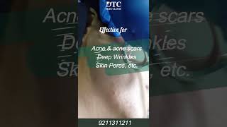 Fractional Laser Treatment  DTC Skin Clinic [upl. by Spillar704]