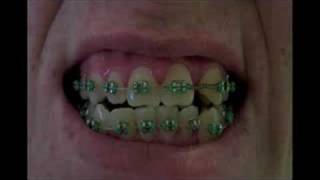 Braces before during and after [upl. by Ylsel]