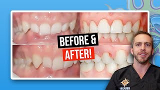 Braces time lapseoverbite and overjet correction braces before after [upl. by Clover]