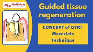 Guided Tissue Regeneration  Concept of GTR I Periodontal Regeneration l Mediklaas [upl. by Irodim481]