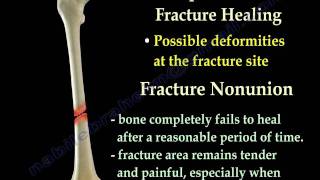 Fracture Healing Part 1  Everything You Need To Know  Dr Nabil Ebraheim [upl. by Ycats]