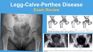 LeggCalvePerthes Disease Coxa Plana Exam Review  Rachel Goldstein MD [upl. by Eugenides836]