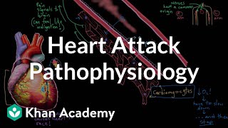 Heart attack myocardial infarction pathophysiology  NCLEXRN  Khan Academy [upl. by Silvano388]