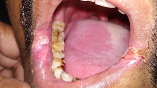 Leukoplakia signs and symptoms [upl. by Analli786]