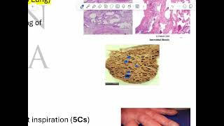 RS pathology 5 restrictive lung diseases [upl. by Yenettirb]