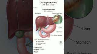 Cholangiocarcinoma shorts [upl. by Kahaleel]