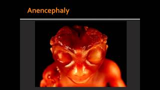 Forebrain Anomalies  Anencephaly amp Holoprosencephaly [upl. by Nidya]