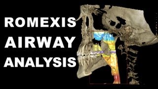 Romexis Airway Analysis [upl. by Hairu]