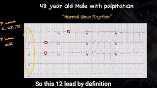 What defines a true normal sinus rhythm on a 12lead ECG [upl. by Desiri]