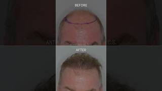 Restoring the frontal forelock  Anthony Bared MD FACS  Miami FL [upl. by Angelica]