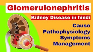 Glomerulonephritis  Nephritis in hindi  kidney disease  medical surgical nursing lecture [upl. by Hctub423]