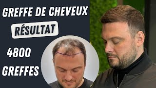 Résultat de la greffe de cheveux 4800 greffons l Avant et après l Greffe de cheveux en Turqui [upl. by Barthold156]