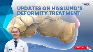 Updates on Haglunds deformity treatment [upl. by Savanna]