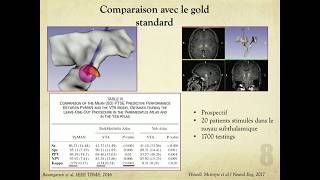 Stimulation cérébrale profonde assistée par l’imagerie multimodale [upl. by Nyra]