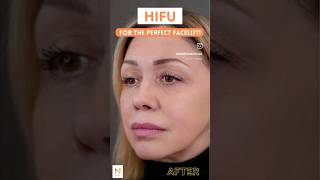 HIFU Treatment Before amp After hifutreatment hifufacial hifufacelifting facelift [upl. by Popele]