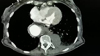 Aortic Aneurysm CT JETem 2018 [upl. by Hillman324]