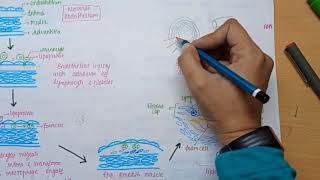 Atherosclerosis  Cause  pathology  Coronary Artery Disease in Hindi [upl. by Enihsnus]