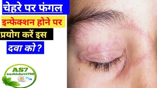 चेहरे के Fungal Infection का इलाज  Ringworm Treatment [upl. by Etra]