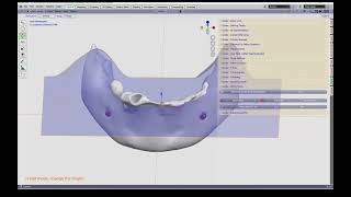 Bone Cutter for stackable guides [upl. by Dayiz]