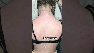 my accutane journey shortsfeed acne accutane acnejourney [upl. by Ardnayek564]