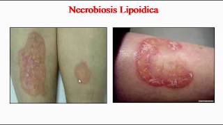 Necrobiosis Lipoidica [upl. by Ocisnarf]