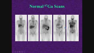 Infection and Inflammation Scintigraphy by Christopher J Palestro MD FSNMMI [upl. by Selima474]