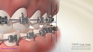 Elastics  Crossbite  Orthodontic Treatment [upl. by Savior]