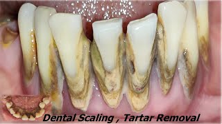 Tartar Removal in Lower Teeth I ScalingTeeth whitening I पत्थर के जैसे पायरिया का इलाजI Dr Ram MDS [upl. by Idnic]