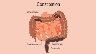 ACUPUNCTURE FOR CONSTIPATION [upl. by Kcitrap]