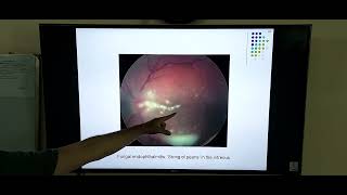 Endophthalmitis Post op after cataract surgery [upl. by Spike]