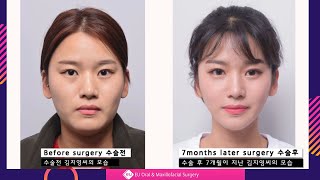 Facial Contouring  Vline Surgery amp Cheekbone Reduction Surgery Review [upl. by Evie]