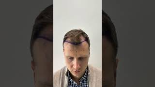 Hair Transplant Result  Hair Transplant Timelapse  Hair Transplant in Turkey  Hair Transplant [upl. by Bywaters]