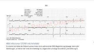 EKG in 3 Minuten 9 [upl. by Cuthbert]