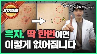 왜 레이저 10번이나 받으세요 흑자 제거는 1번 만에 치료되는데😭 힘들게 병원 왔다 갔다 하지 마세요 [upl. by Sholeen]