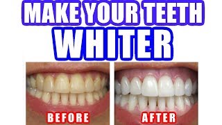 How to Whiten Teeth amp Make Your Teeth Whiter Naturally at Home BEST METHOD [upl. by Adnilemre]