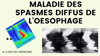 Maladie des spasmes diffus de loesophage [upl. by Ikilisav]