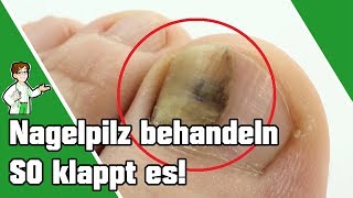 Nagelpilz behandeln  SO klappt es 👣💅 [upl. by Tolmann412]