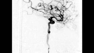 Endovascular treatment of a complex bilobed left superior hypophyseal ICA aneurysm [upl. by Nona]