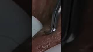 pimple popping 2022 new blackheads amp whiteheadsacne tiktok 2022short [upl. by Giorgio]