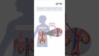 Síndrome de Wilkie y Síndrome de Ligamento Arcuato Medio y su sintomatología más frecuente [upl. by Dej279]