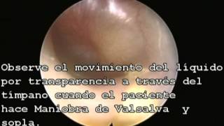 Otitis media con efusion video mov timpanicoavi [upl. by Ahtikal954]